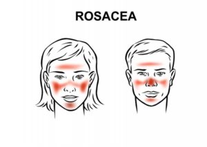 Rosacea-Areas- What You Didn’t Know